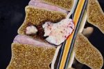 Метастазы при раке предстательной железы и кости: почему болит спина