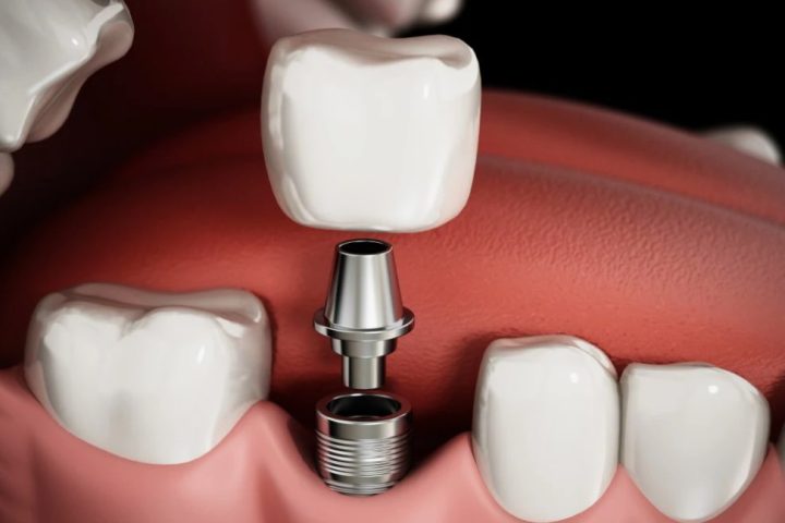 Как проходит имплантация зубов пошагово — от диагностики до идеальной улыбки