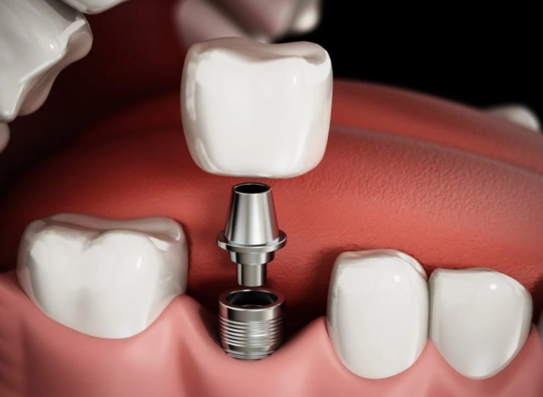 Как проходит имплантация зубов пошагово — от диагностики до идеальной улыбки